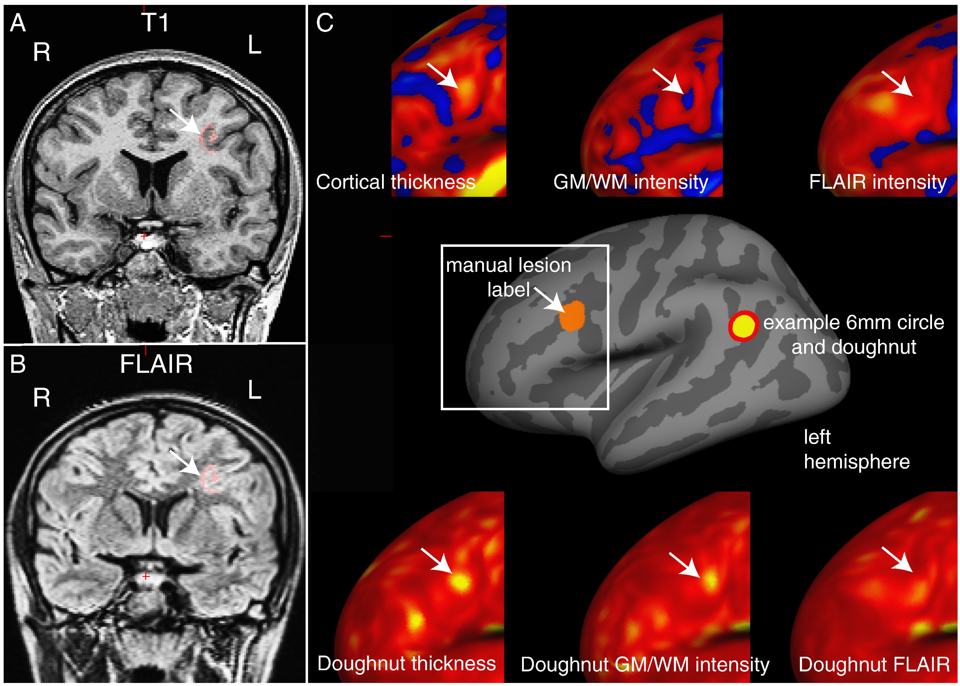 Automated Detection of Focal Cortical Dysplasia With the FCDdetection ...