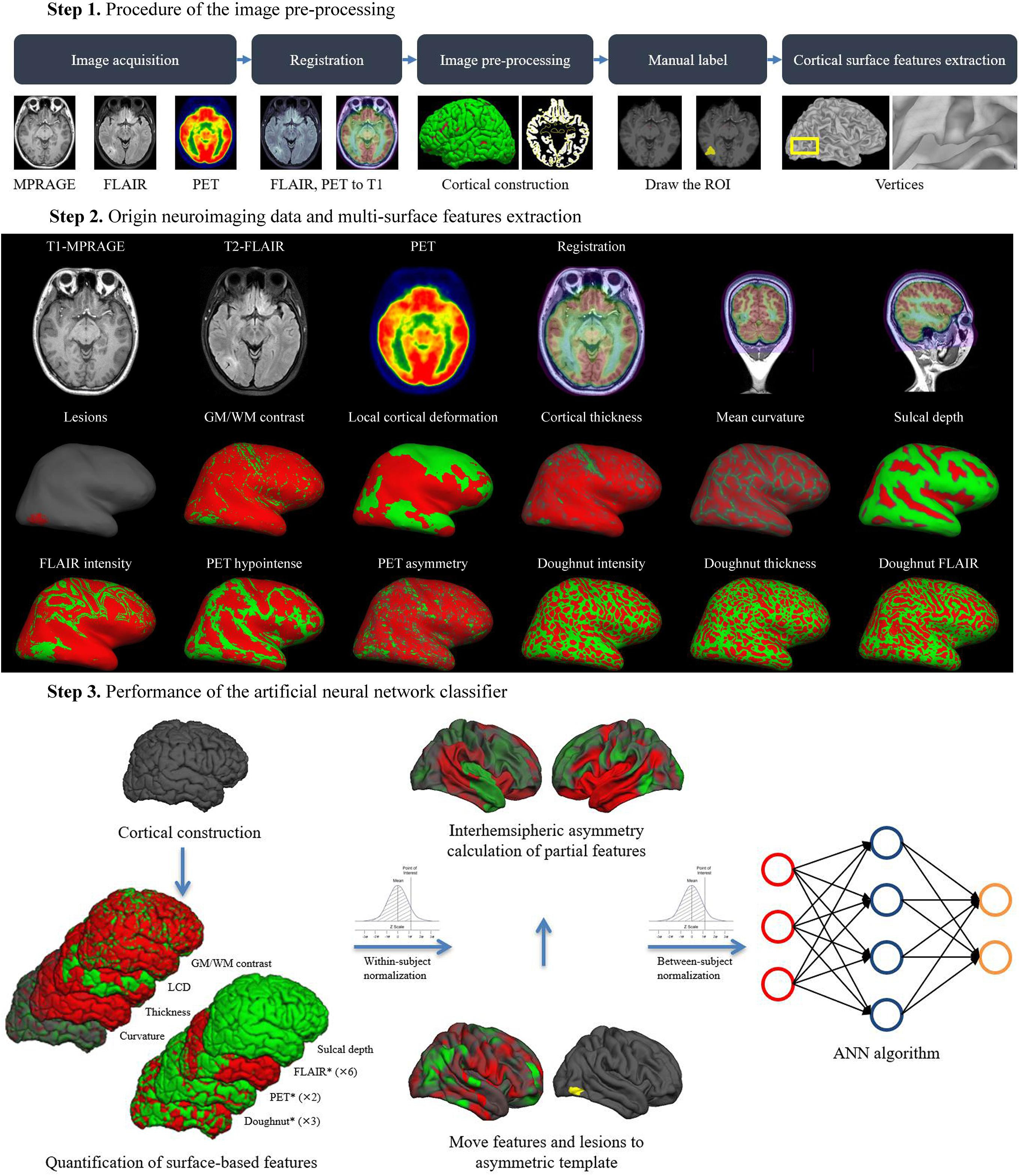 Automated Detection of Focal Cortical Dysplasia With the FCDdetection ...